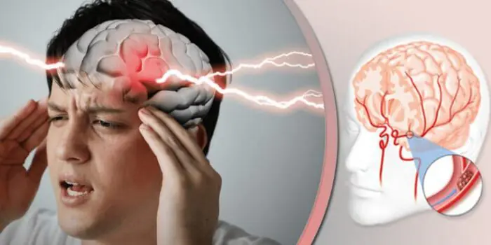 پاورپوینت درباره سکته مغزی